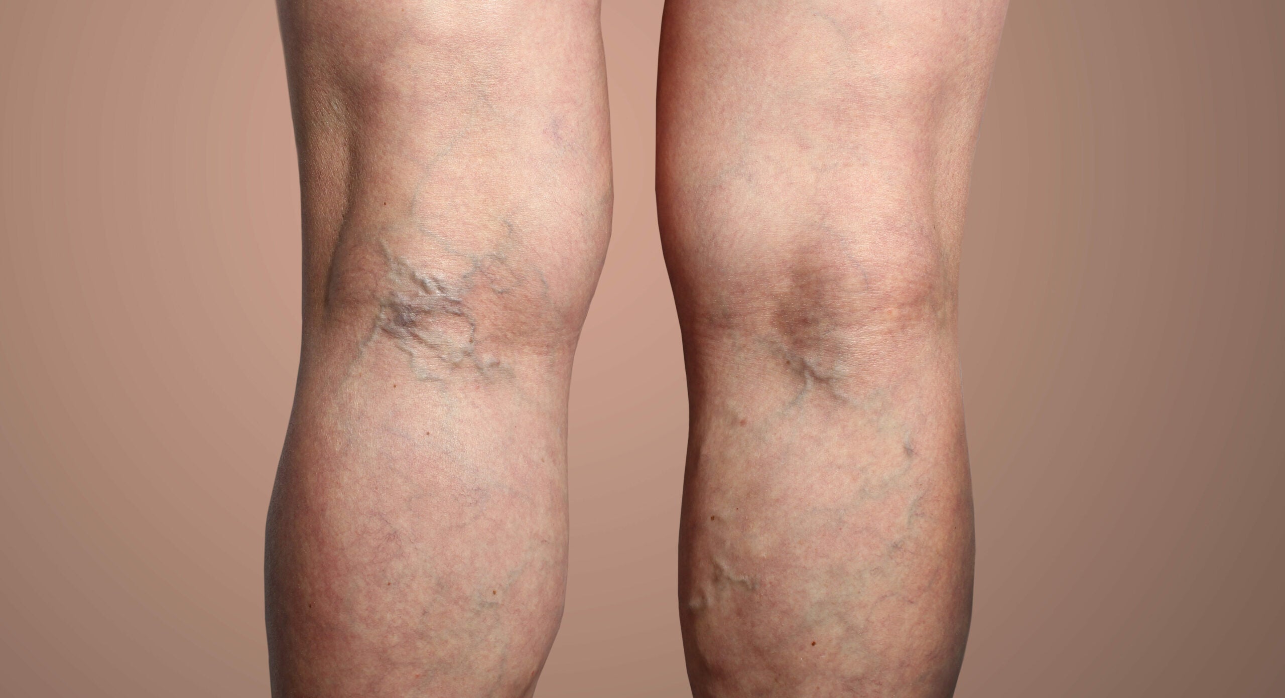 Alt du skal vide om åreknuder i underlivet, lysken og på benene