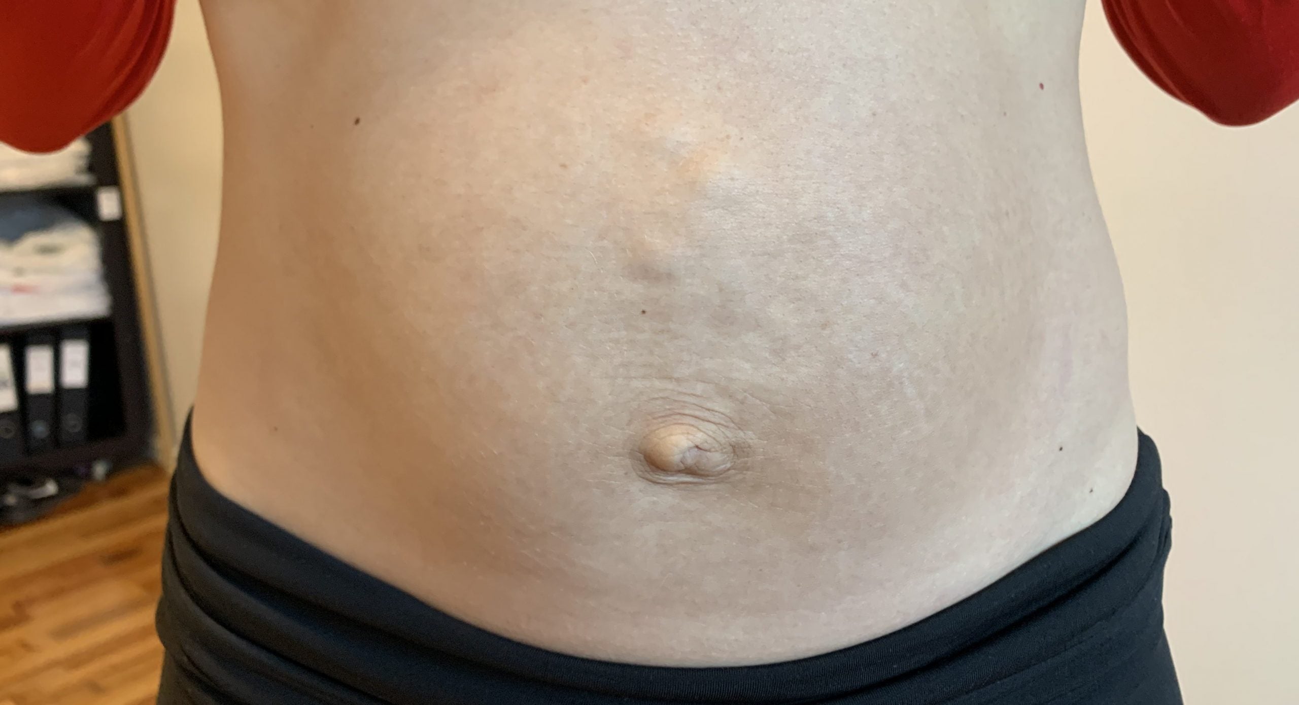 rectus diastase delte mavemuskler efter fødsel