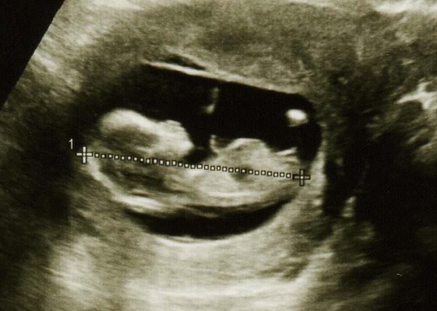 nub theory scanningsbillede af pige