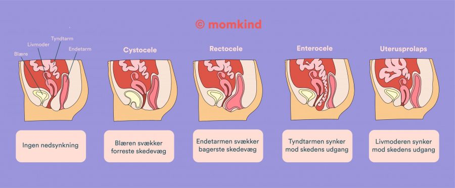 underlivsprolaps illustration viser forskellige typer af nedsynkning