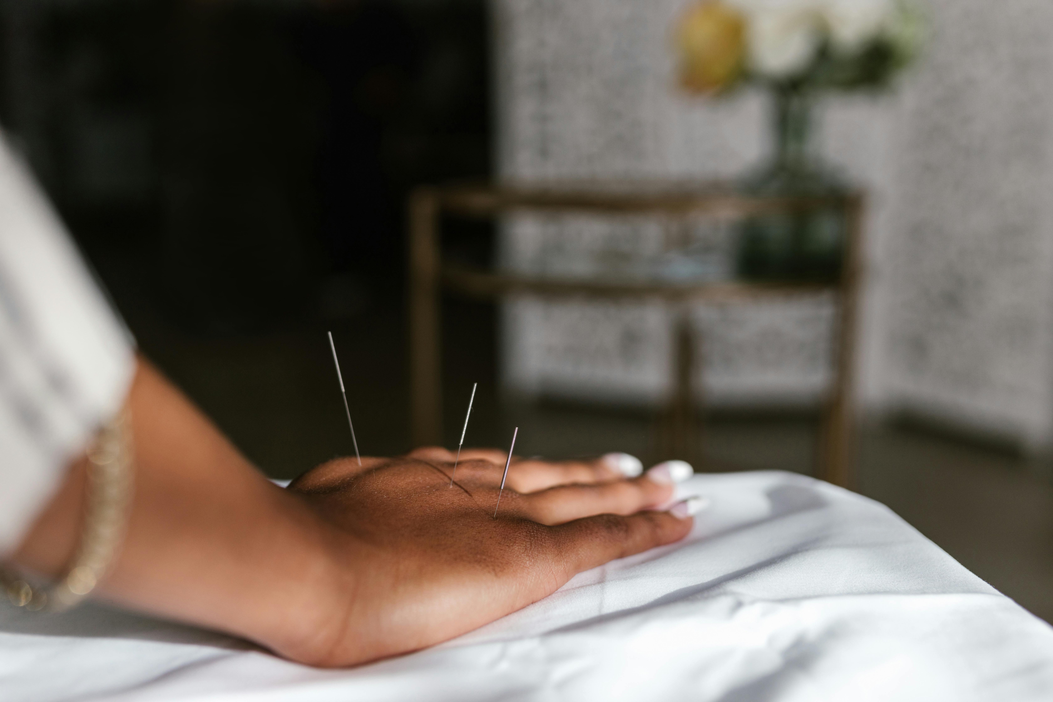 akupunktur i hånd