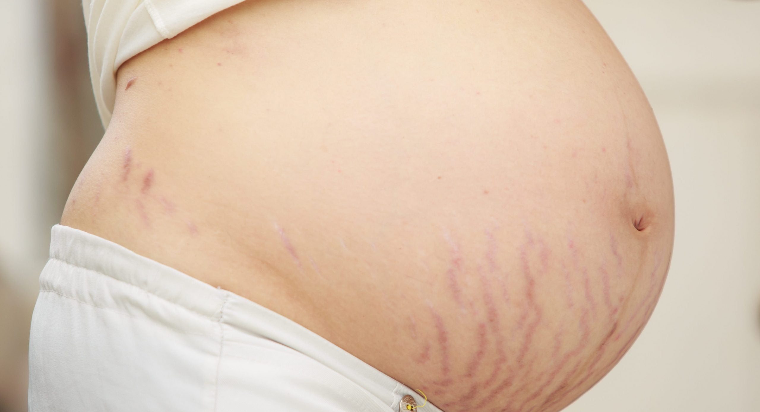 skrækmærker på gravid mave hvad kan man gøre ved strækmærker